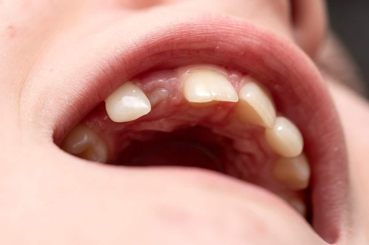 teeth gap in child month that needs space maintainer