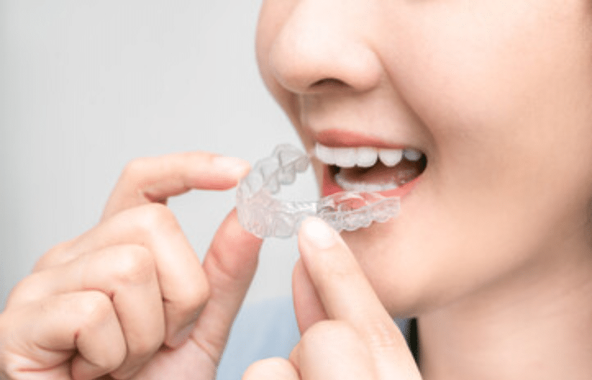 Featured image for “How Often Should I Clean My Invisalign?”