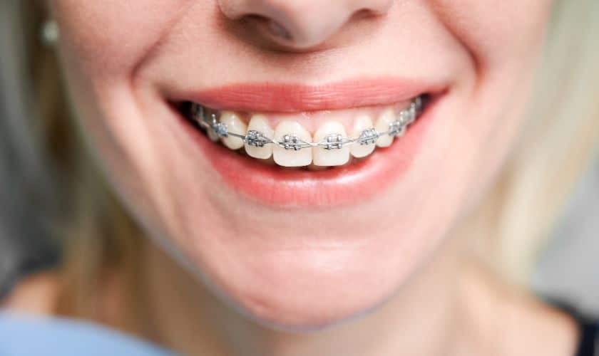 Orthodontics and Facial Aesthetics: Achieving a Balance Smile in Phoenix - Woolaver Orthodontics