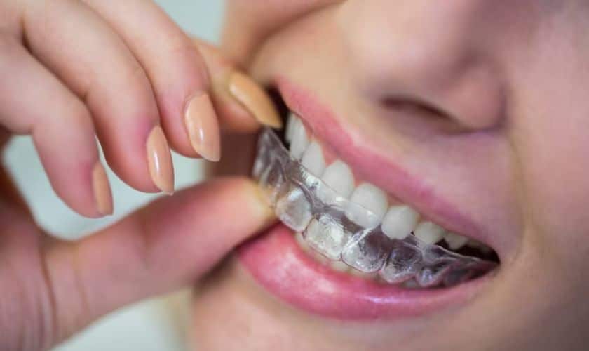 Invisalign in Phonix - Woolaver Orthodontics