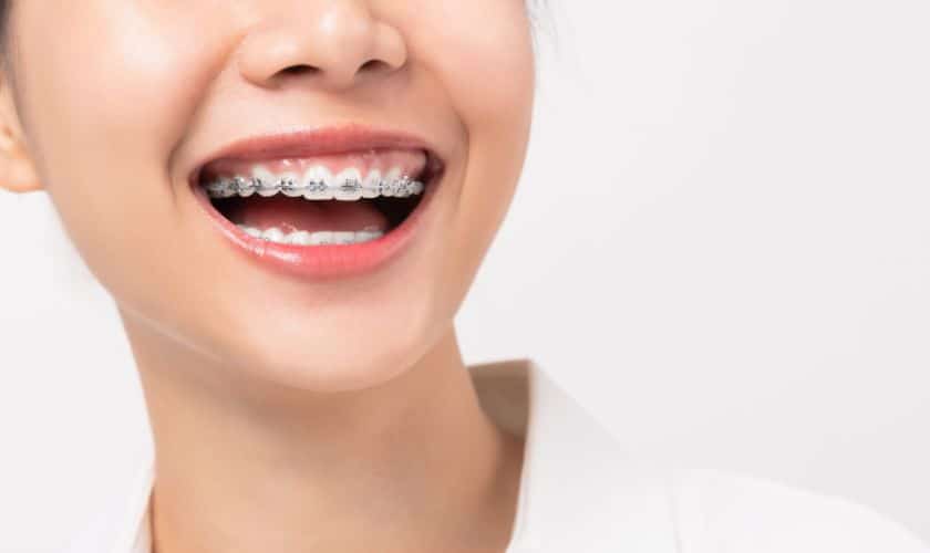 Braces in Phoenix