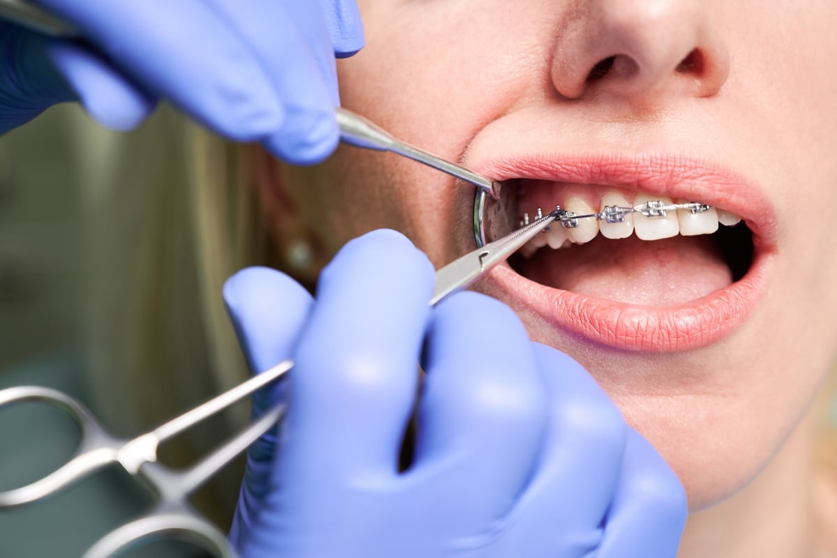Braces
