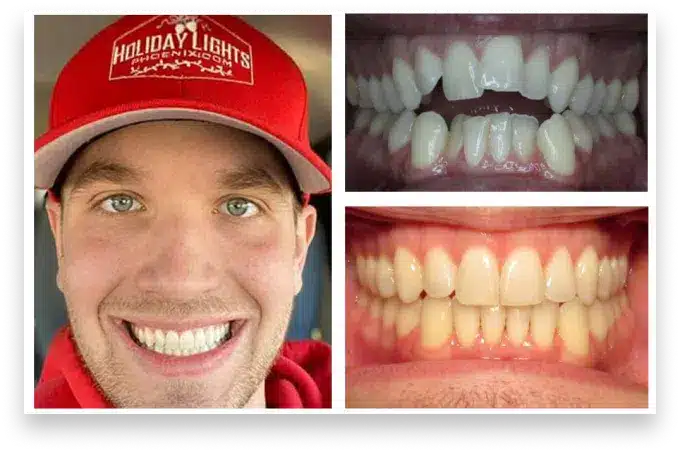 Invisalign Ahwatukee patient Result Before After