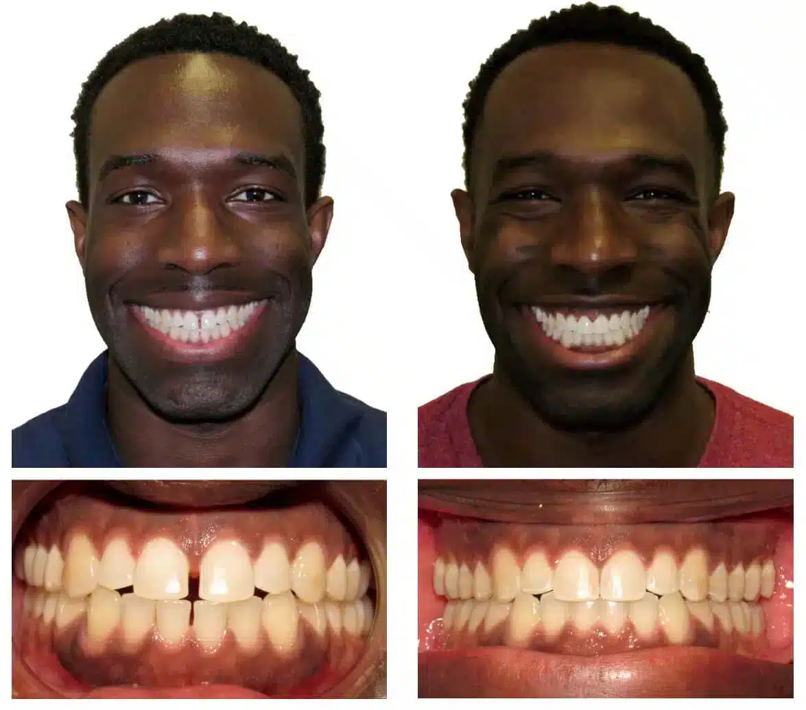 Invisaling Express Before After