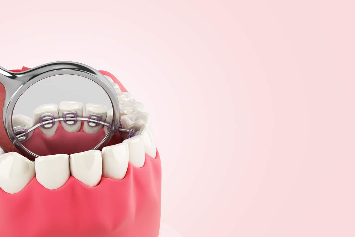Braces Damage Enamel