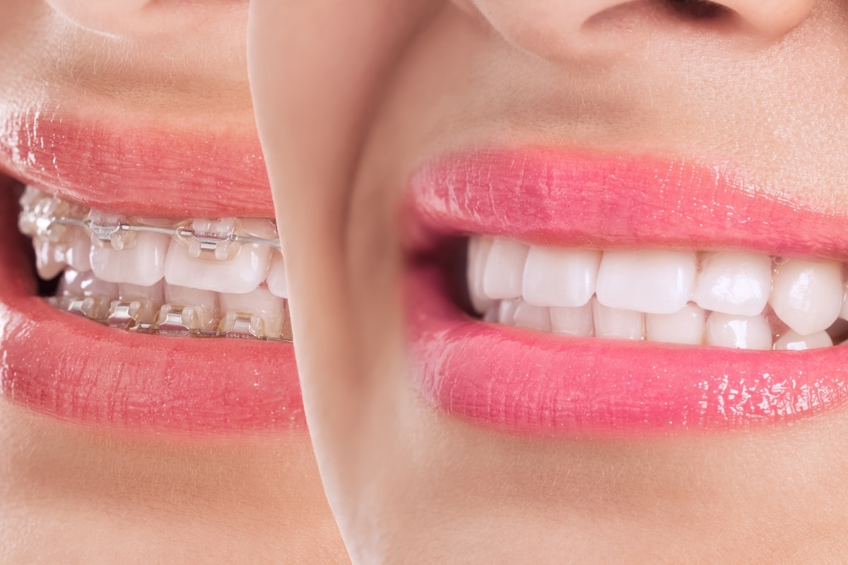 Decalcification After Braces