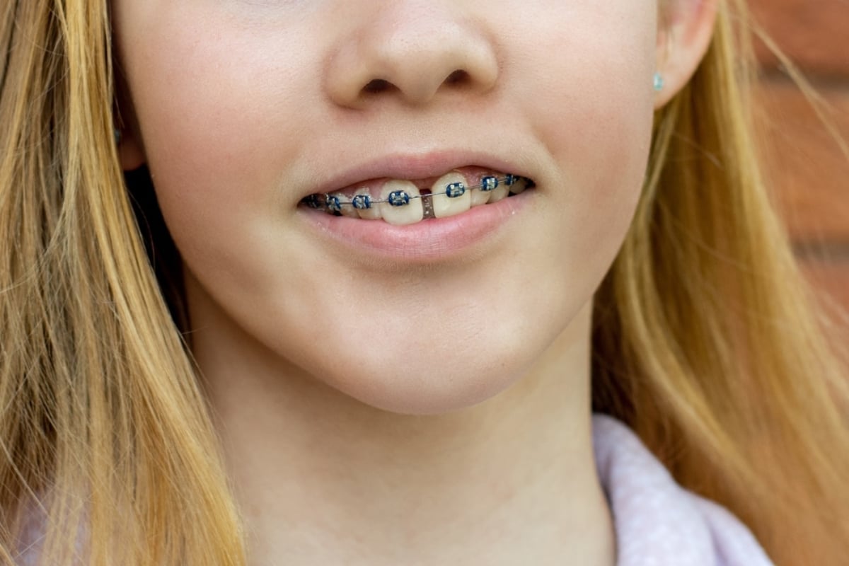 child wearing braces at early age