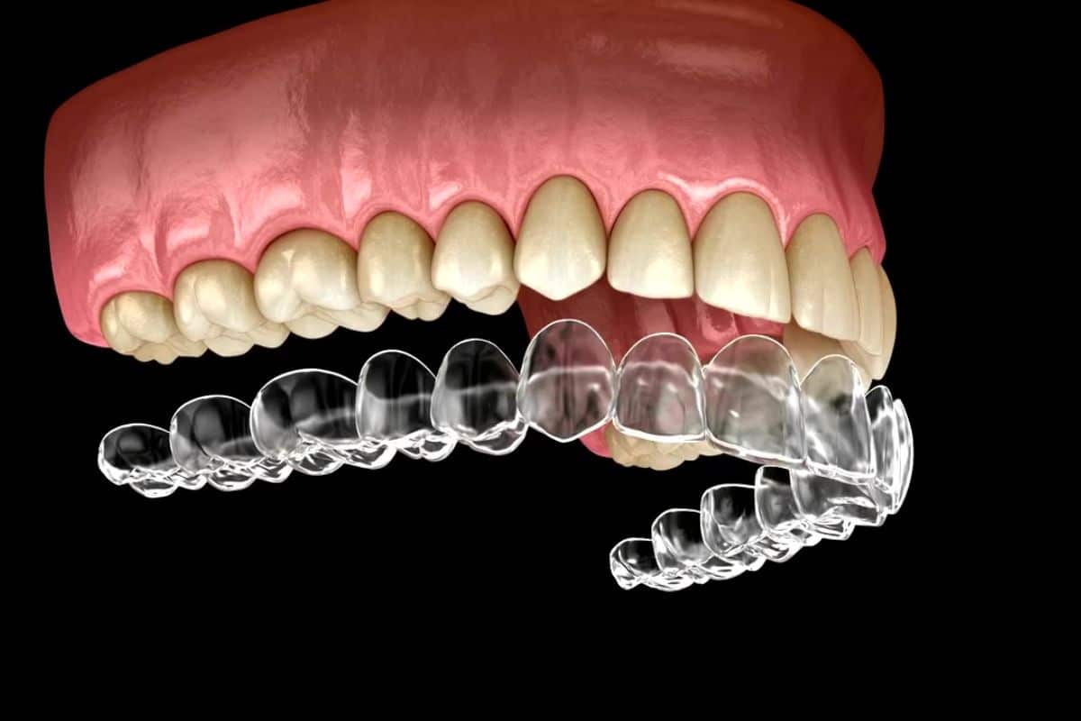 Featured image for “Exploring the Quick and Discreet Wonders of Invisalign Express”