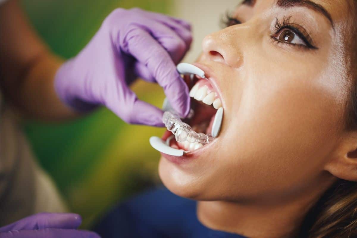 woman starting Invisalign treatment when having veneers