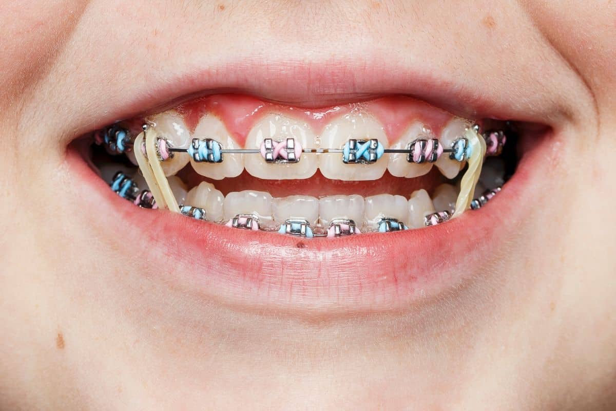 rubber bands in orthodontic treatment