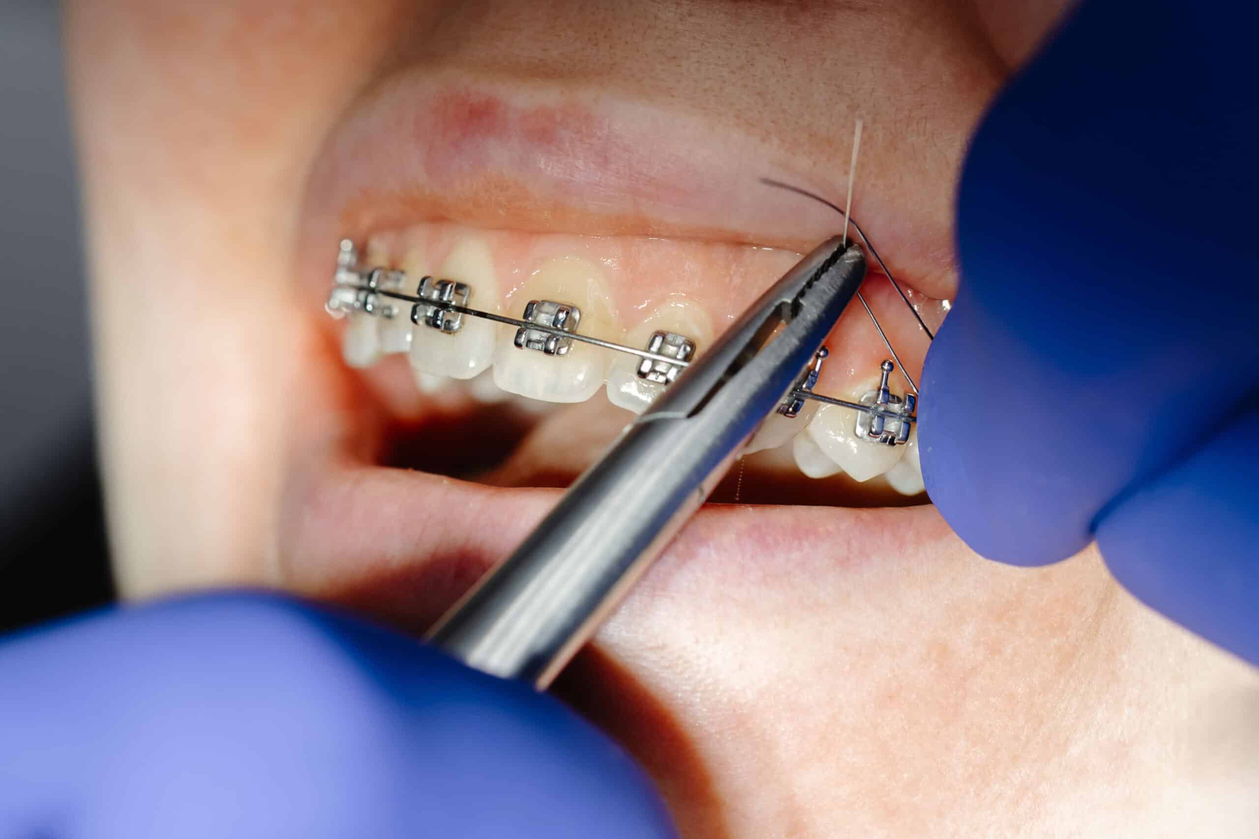 orthodontist fixing pokey wires of braces