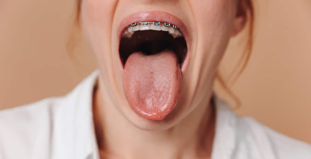 close up of a woman-showing dry tongue after getting braces