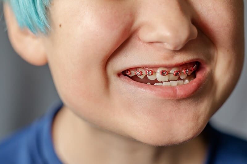 Featured image for “Braces For Your Child – Common Signs & Early Indicators”