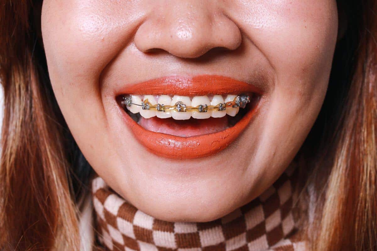 Featured image for “Do Braces Change Jawline and Reshape Face Shape in Adults?”