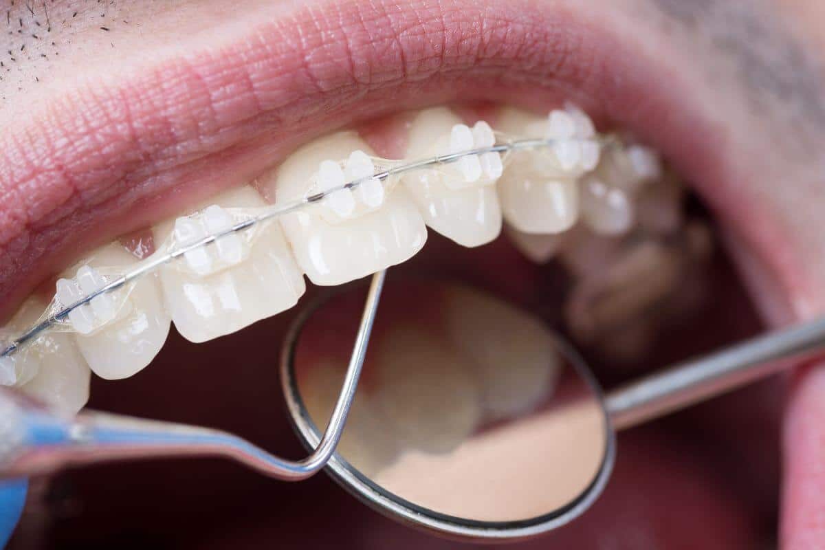 Featured image for “What to Expect in Your First Few Weeks with Ceramic (Clear) Braces”