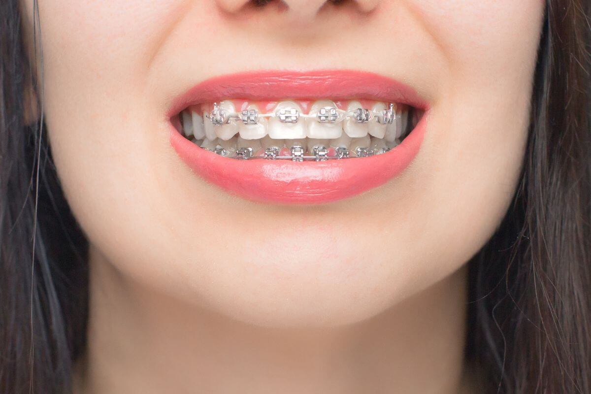 woman wearing braces with sensitive teeth