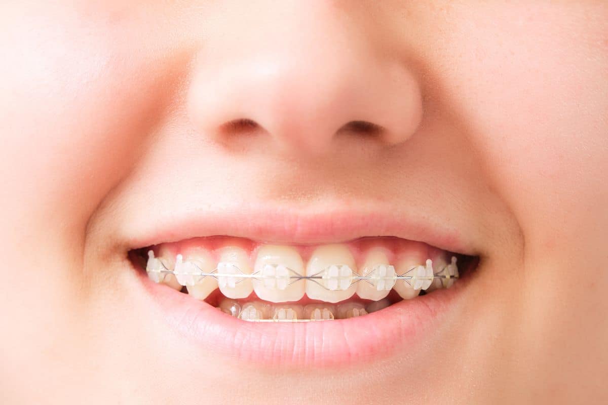 Featured image for “How to Avoid Staining and Discoloration with Clear Braces”